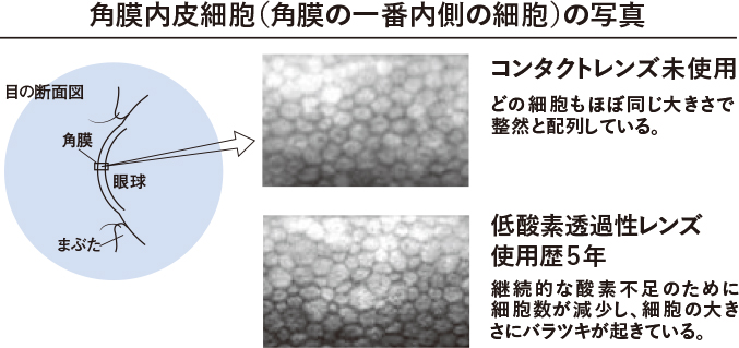 角膜浸潤